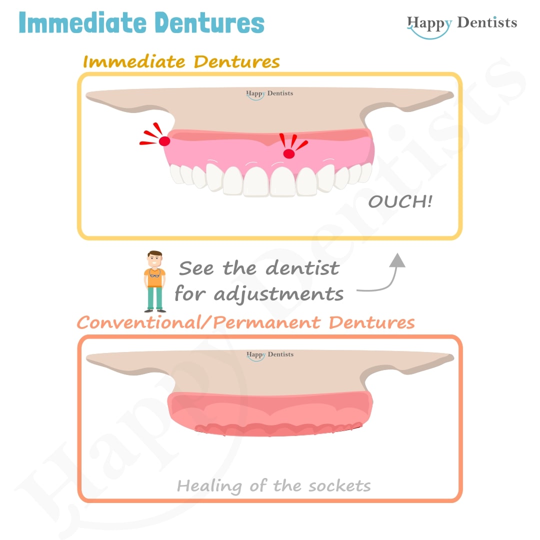 Immediate Dentures, Denture Animation