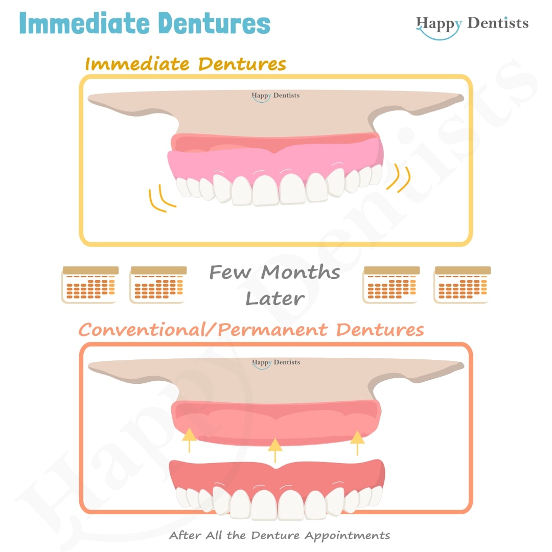 Immediate Dentures, Denture Animation