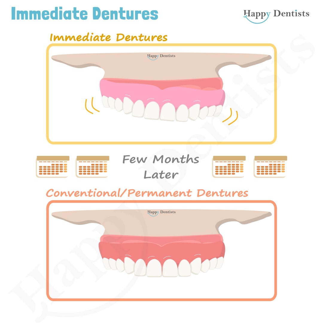 Immediate Dentures, Denture Animation