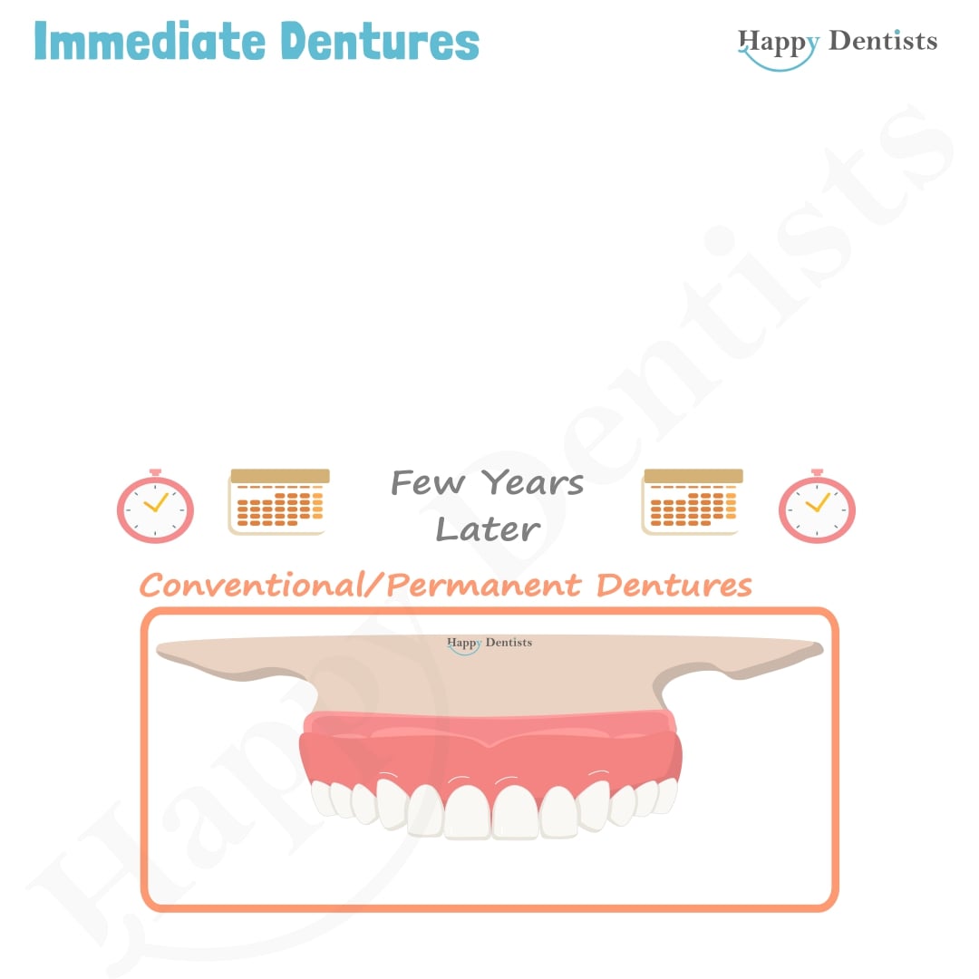 Immediate Dentures, Denture Animation