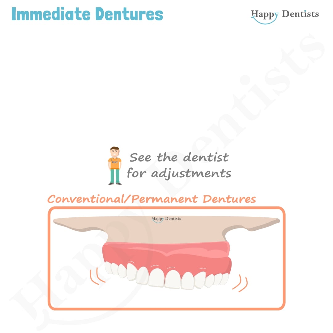 Immediate Dentures, Denture Animation