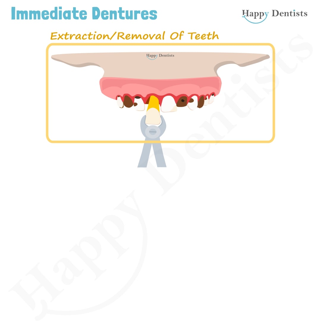 Immediate Dentures, Denture Animation