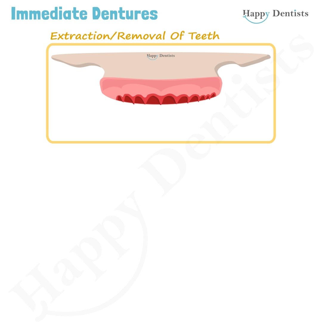 Immediate Dentures, Denture Animation