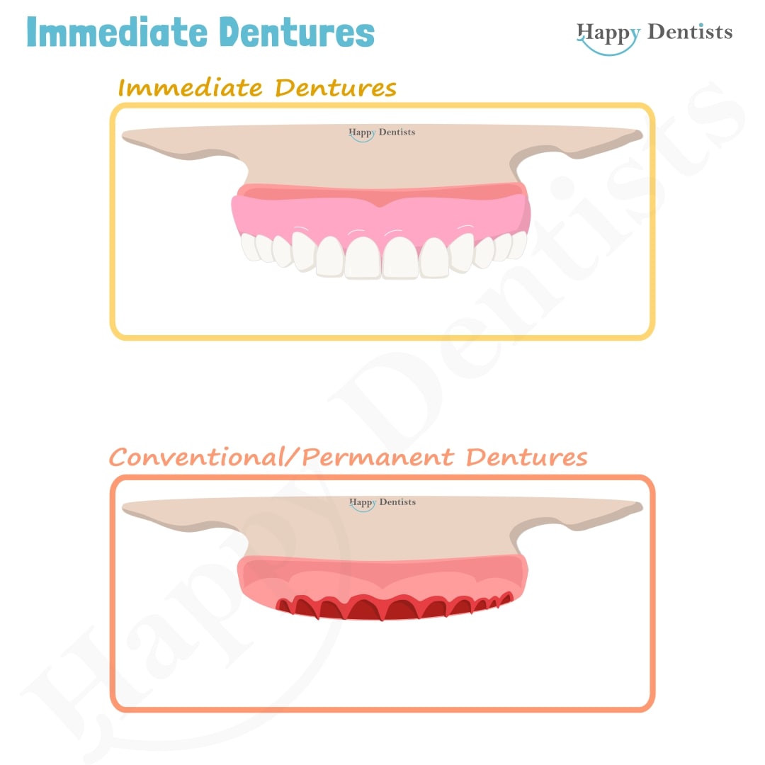 Immediate Dentures, Denture Animation