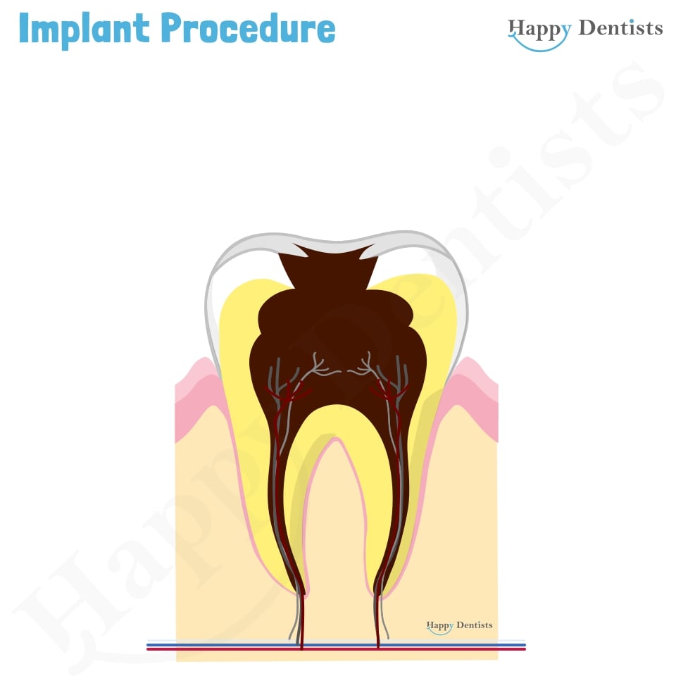 Implant Animation, Dental Implants