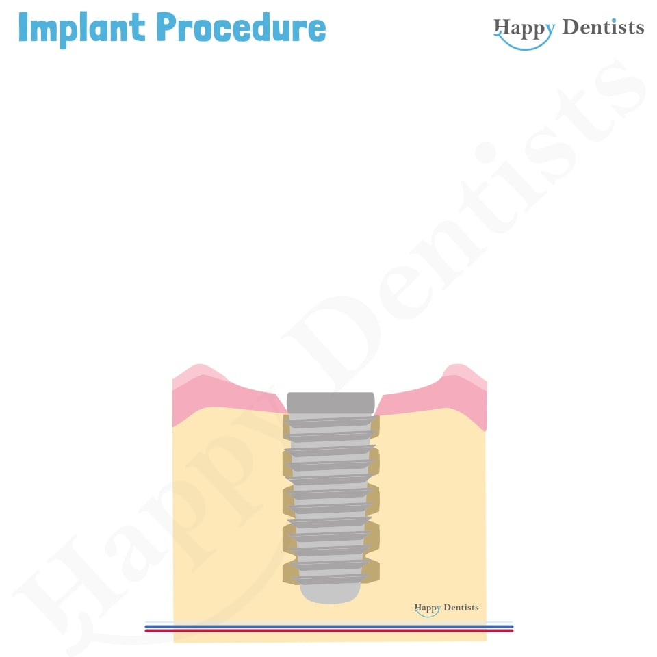 Implant Animation, Dental Implants