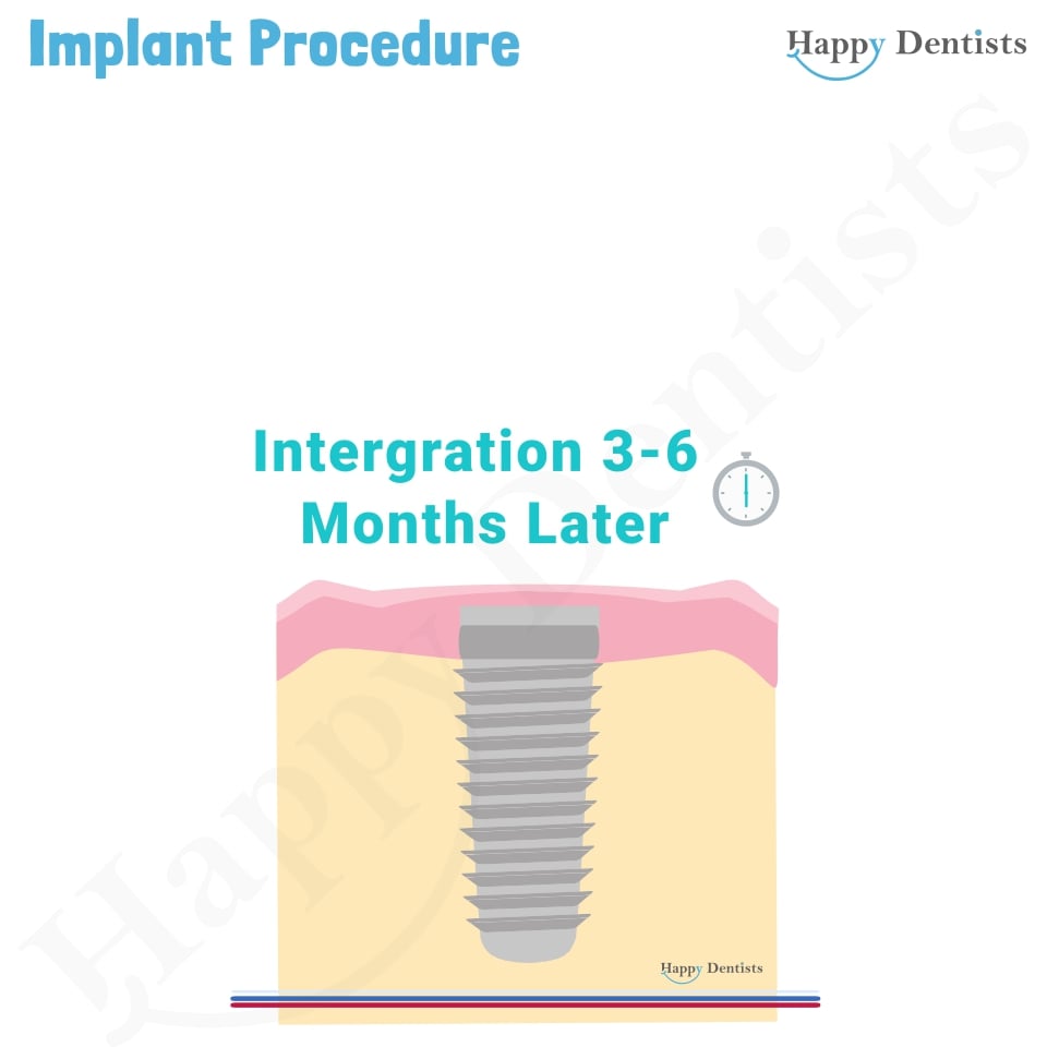 Implant Animation, Dental Implants