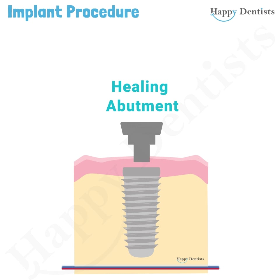 Implant Animation, Dental Implants