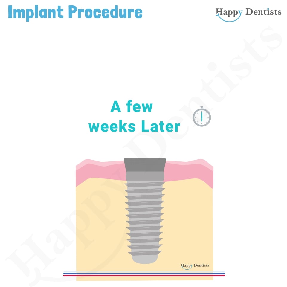 Implant Animation, Dental Implants