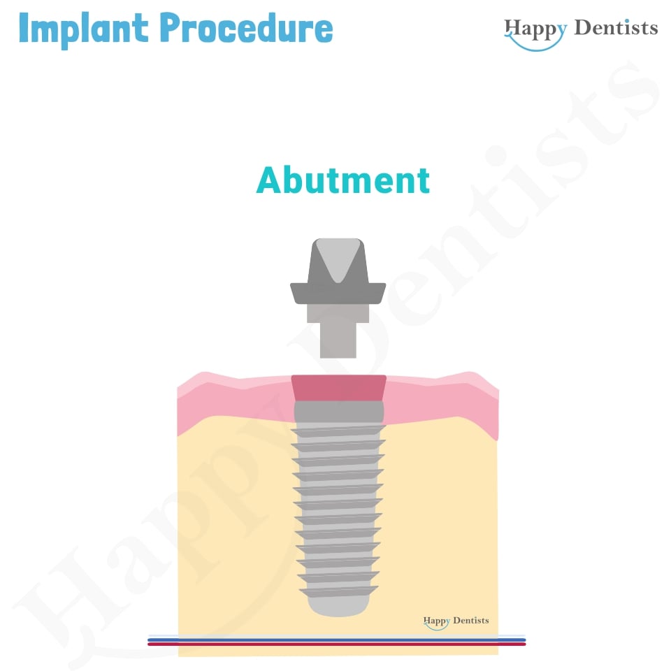 Implant Animation, Dental Implants