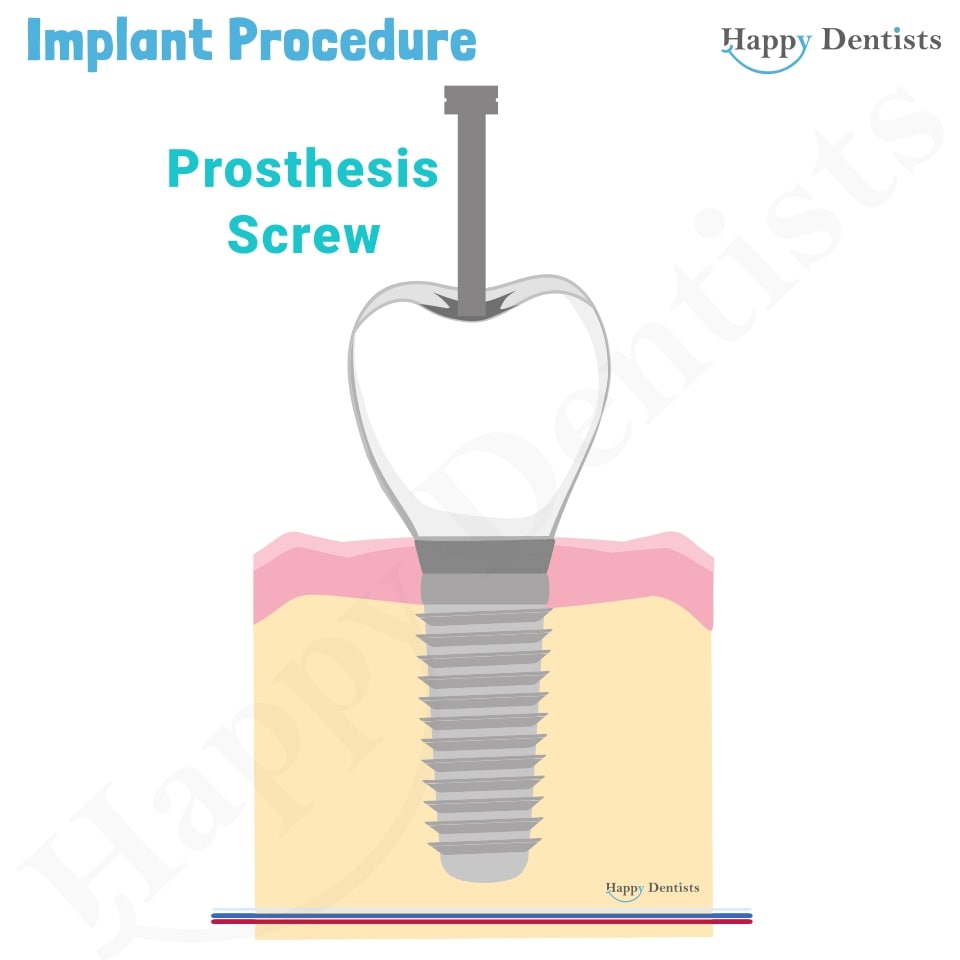 Implant Animation, Dental Implants