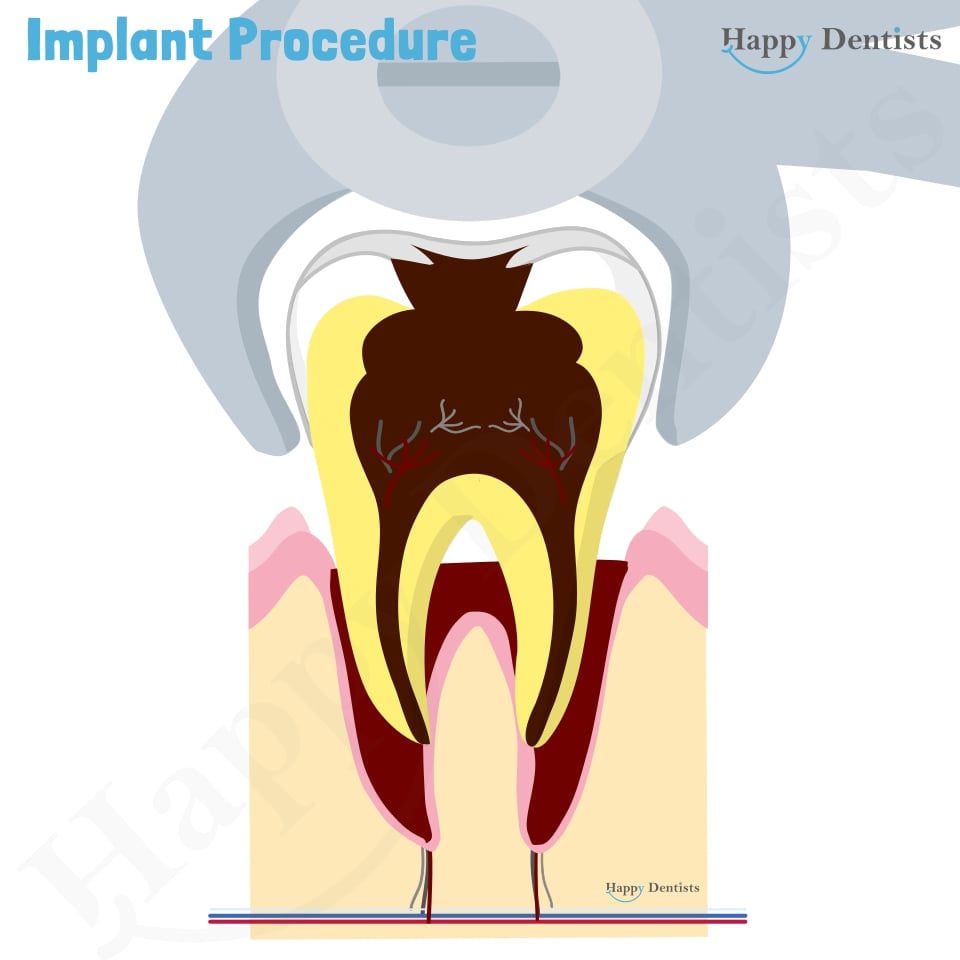 Implant Animation, Dental Implants