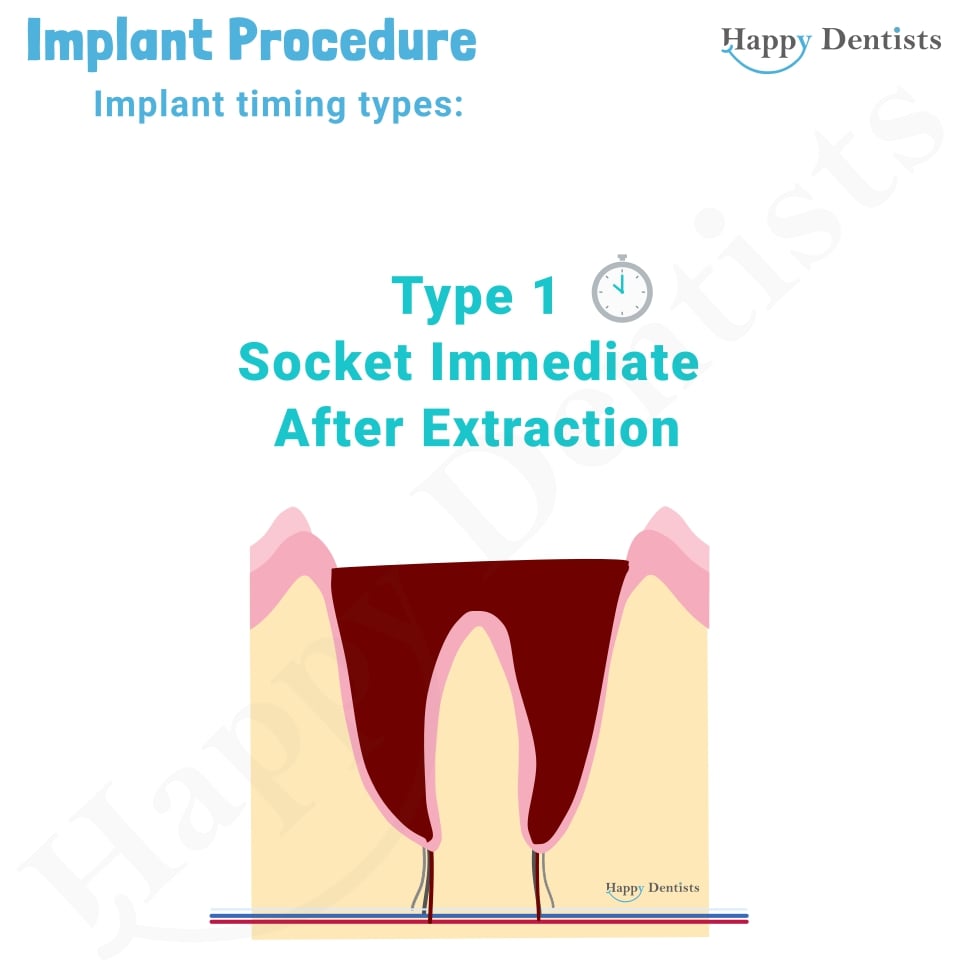 Implant Animation, Dental Implants