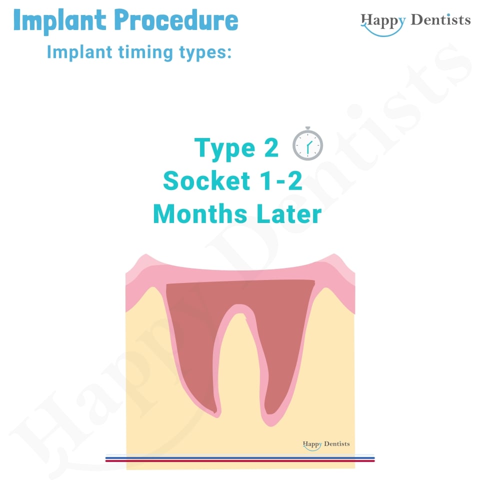 Implant Animation, Dental Implants