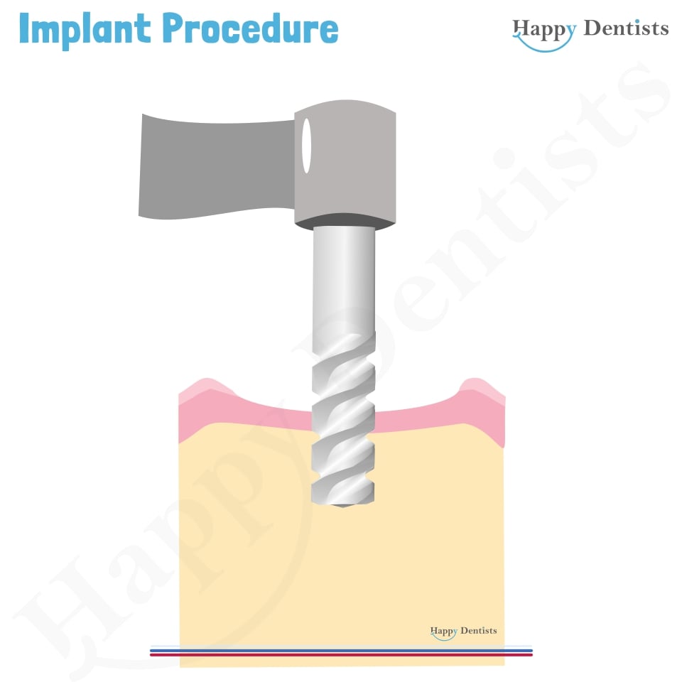 Implant Animation, Dental Implants