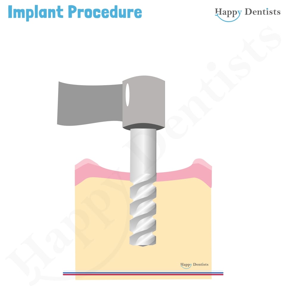 Implant Animation, Dental Implants