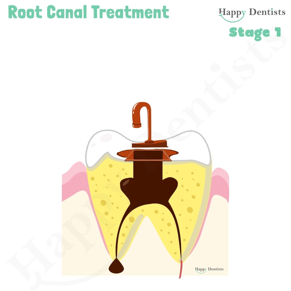 Root Canal Treatment Stages Animation, What is a Root Canal, Root canal treatment?, What is Root Canal treatment?