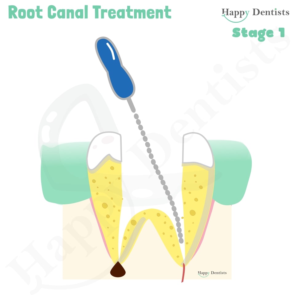 Root Canal Treatment Happy Dentists 