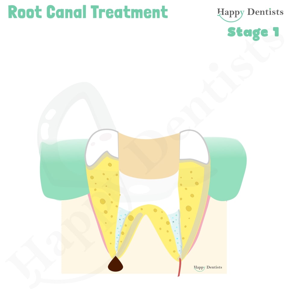 Root Canal Treatment Stages Animation, What is a Root Canal, Root canal treatment?, What is Root Canal treatment?