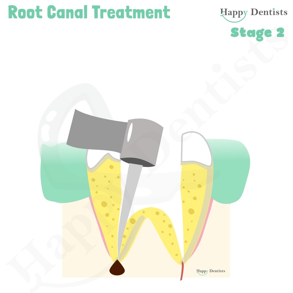 Root Canal Treatment Stages Animation, What is a Root Canal, Root canal treatment?, What is Root Canal treatment?