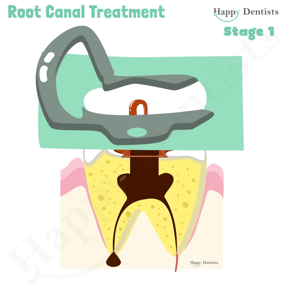 Root Canal Treatment Stages Animation, What is a Root Canal, Root canal treatment?, What is Root Canal treatment?