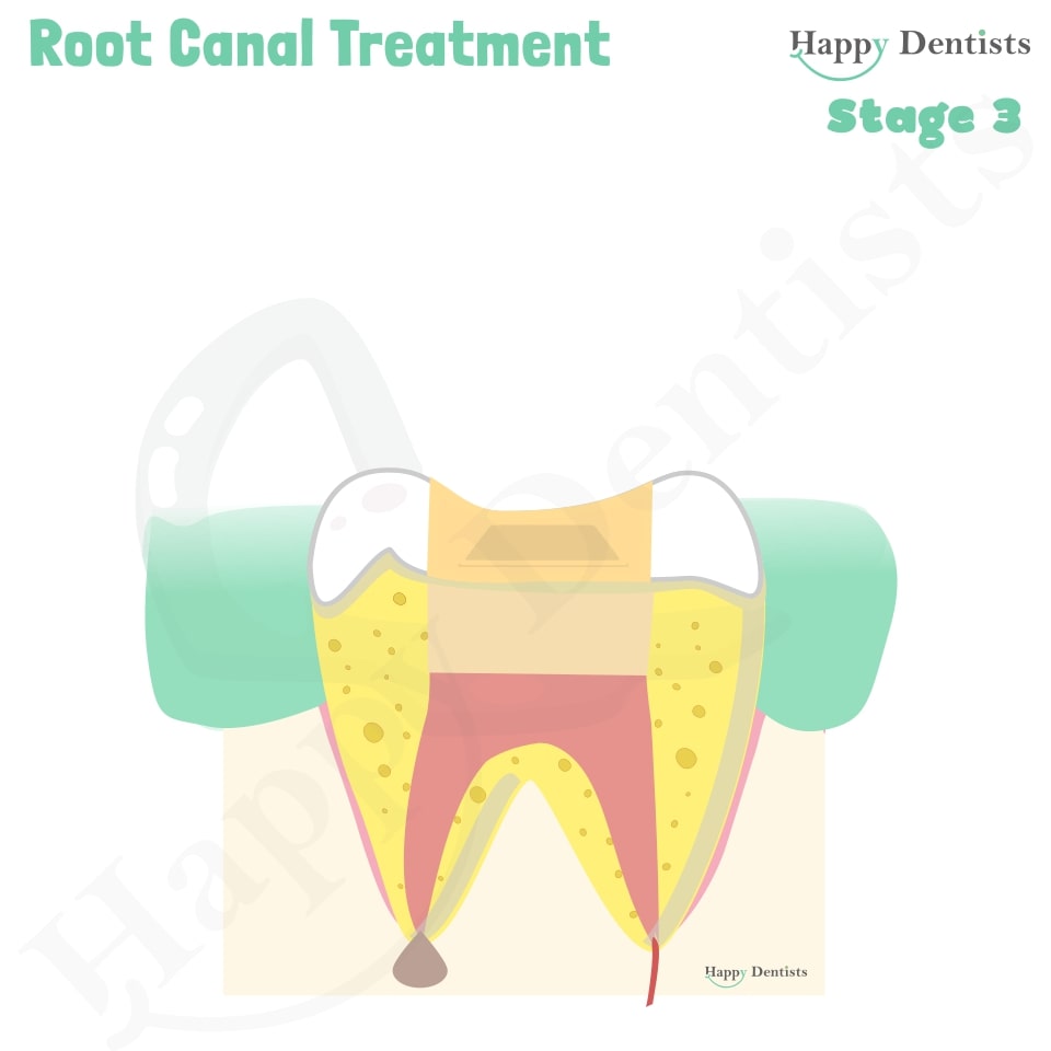 Root Canal Treatment Stages Animation, What is a Root Canal, Root canal treatment?, What is Root Canal treatment?