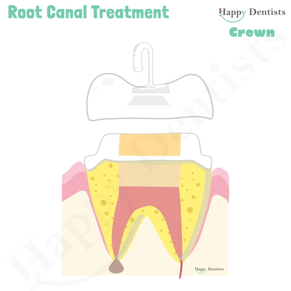 Root Canal Treatment Stages Animation, What is a Root Canal, Root canal treatment?, What is Root Canal treatment?