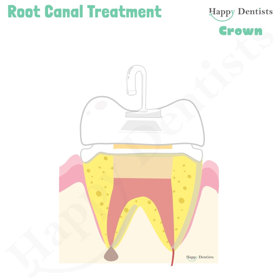 Root Canal Treatment Stages Animation, What is a Root Canal, Root canal treatment?, What is Root Canal treatment?