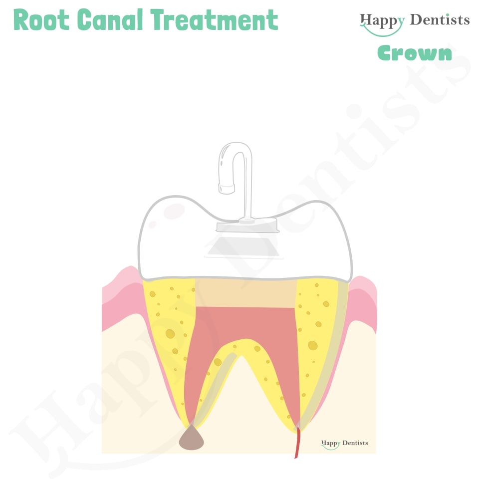 Root Canal Treatment Stages Animation, What is a Root Canal, Root canal treatment?, What is Root Canal treatment?