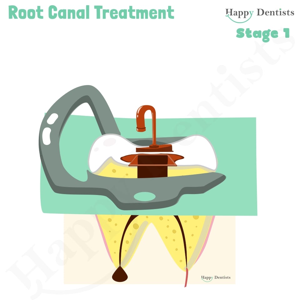 Root Canal Treatment Stages Animation, What is a Root Canal, Root canal treatment?, What is Root Canal treatment?