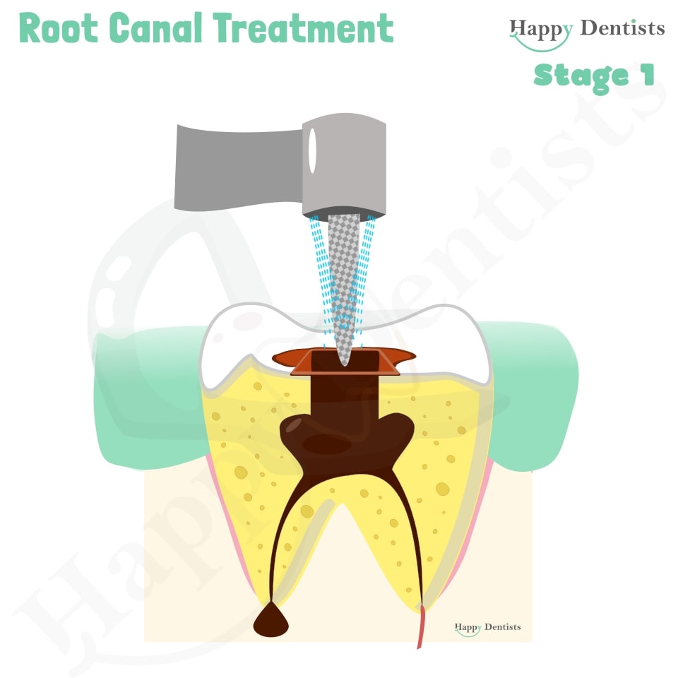 Root Canal Treatment Stages Animation, What is a Root Canal, Root canal treatment?, What is Root Canal treatment?