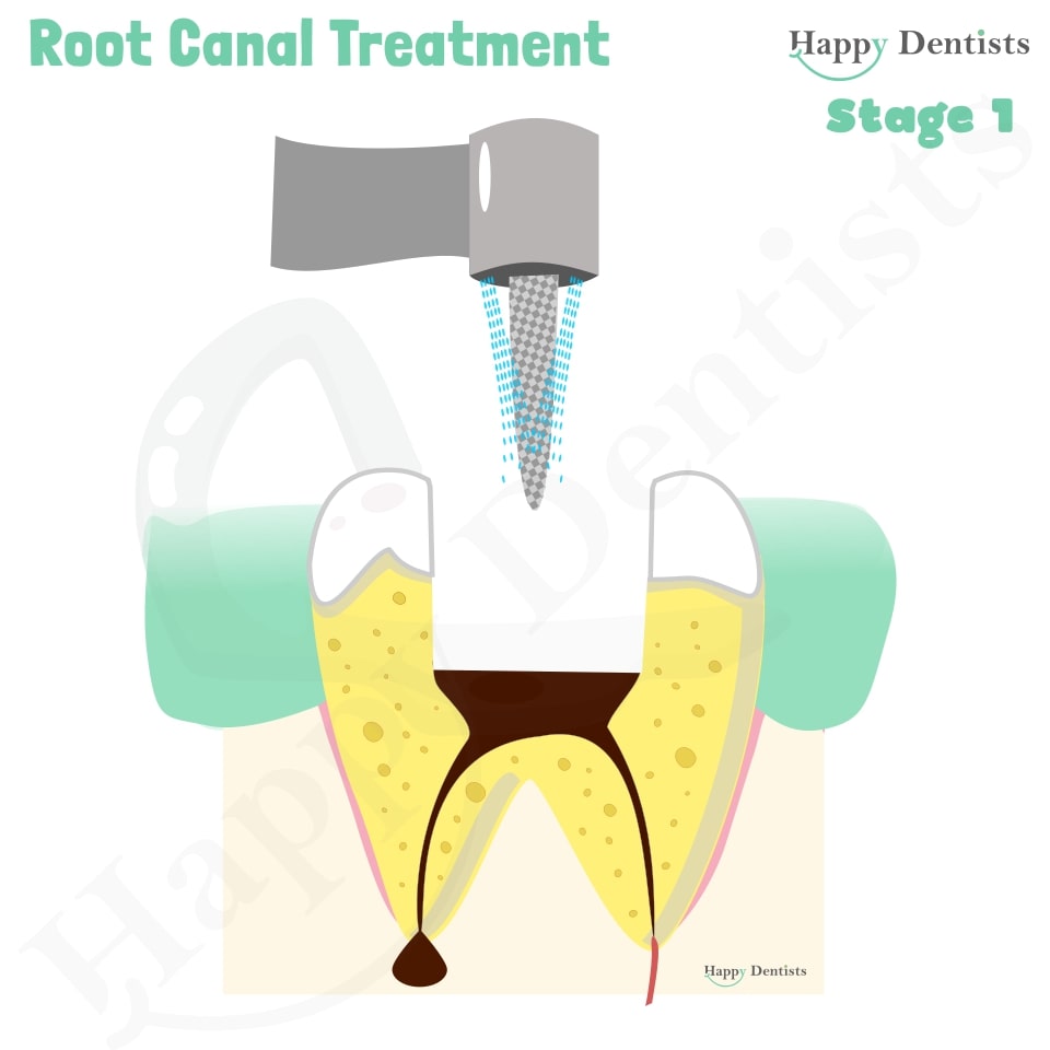 Root Canal Treatment Stages Animation, What is a Root Canal, Root canal treatment?, What is Root Canal treatment?