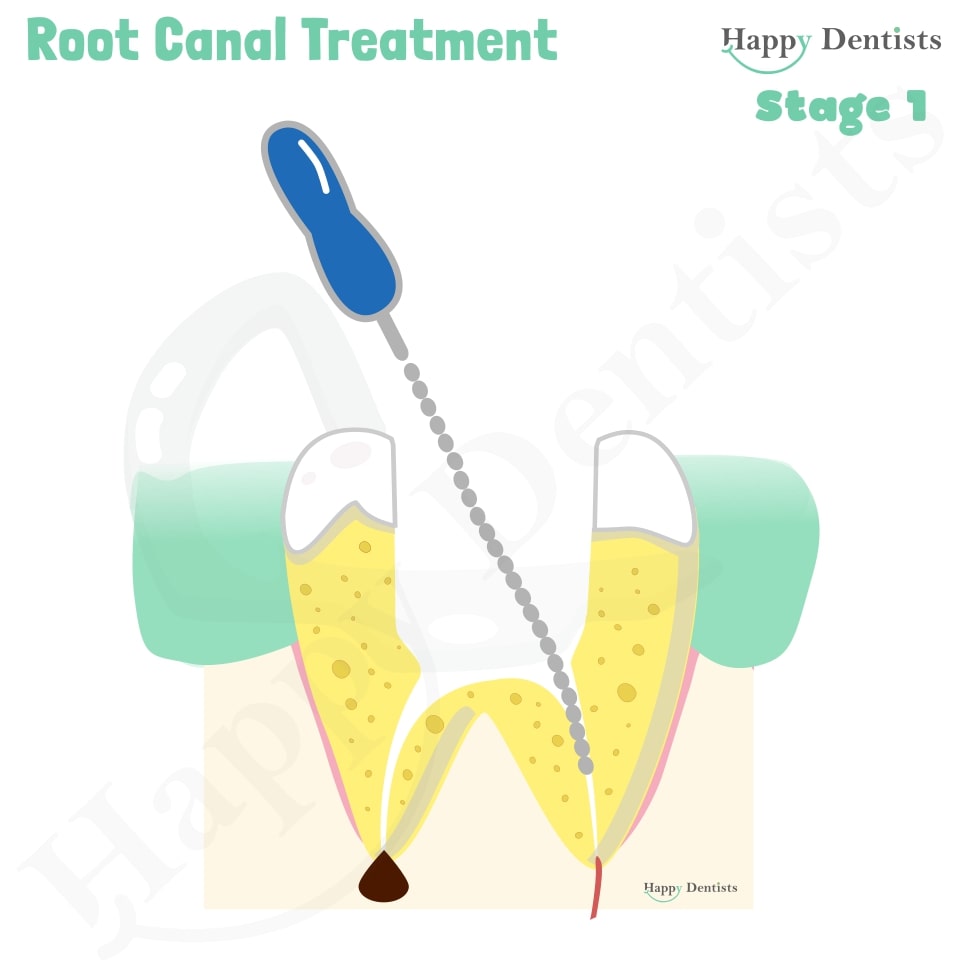 Root Canal Treatment Stages Animation, What is a Root Canal, Root canal treatment?, What is Root Canal treatment?