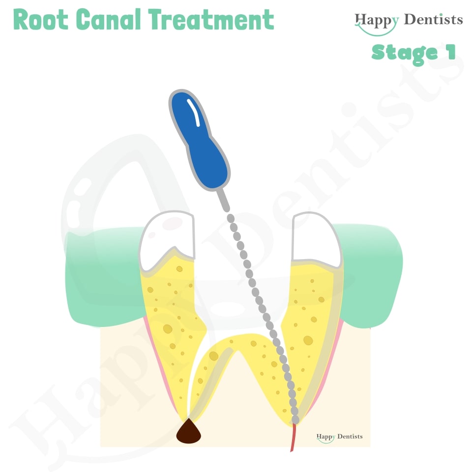 Root Canal Treatment Stages Animation, What is a Root Canal, Root canal treatment?, What is Root Canal treatment?