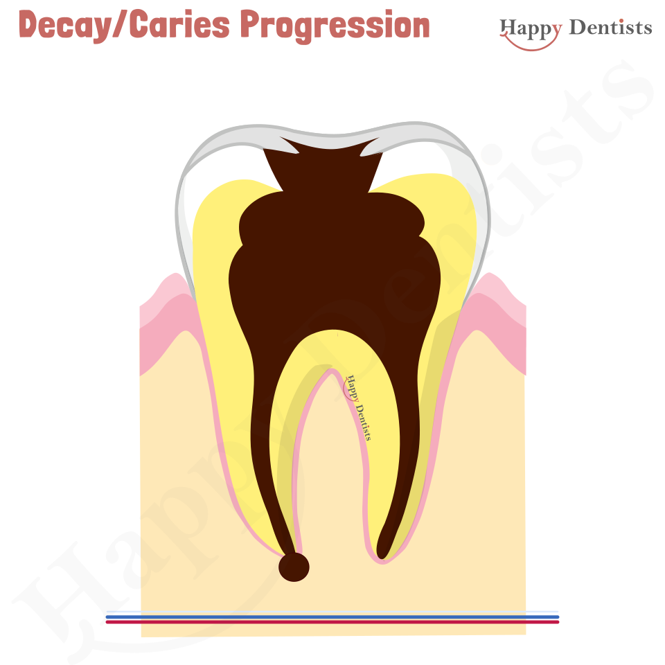 Dental Decay, Caries Animation