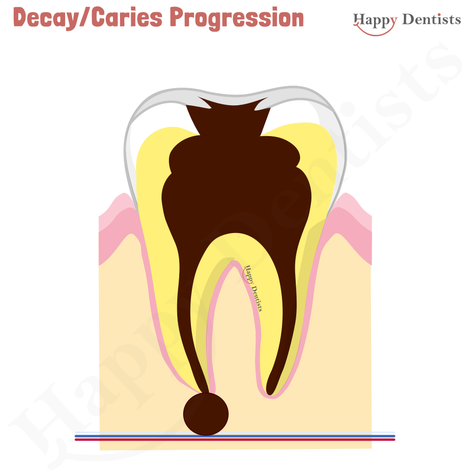 Dental Decay, Caries Animation