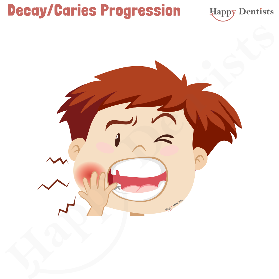 Dental Decay, Caries Animation