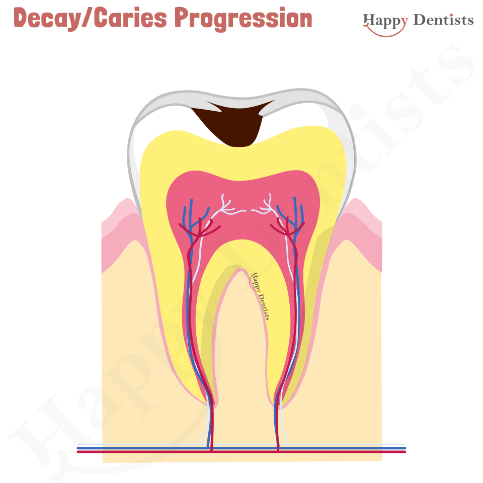 Dental Decay, Caries Animation