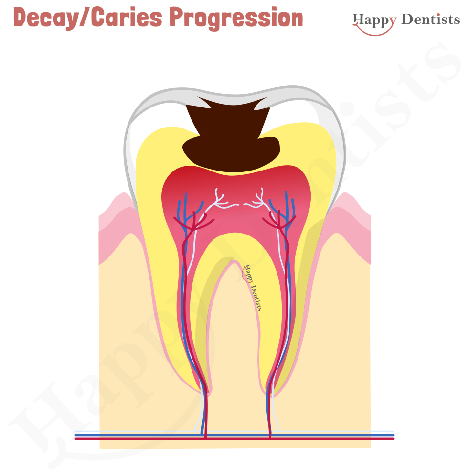 Dental Decay, Caries Animation