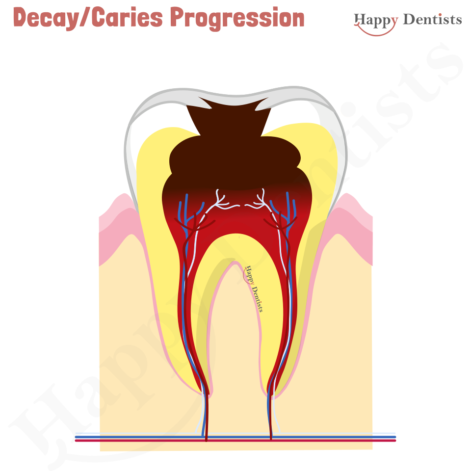 Dental Decay, Caries Animation