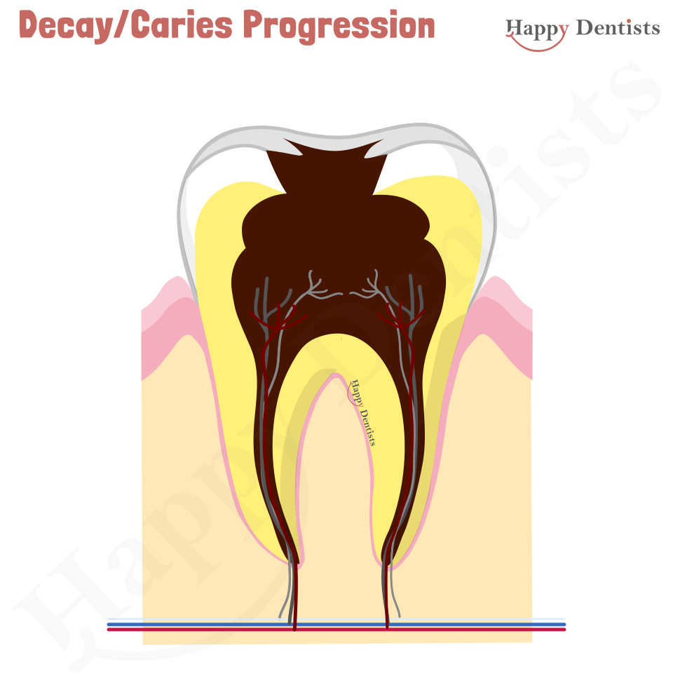 Dental Decay, Caries Animation