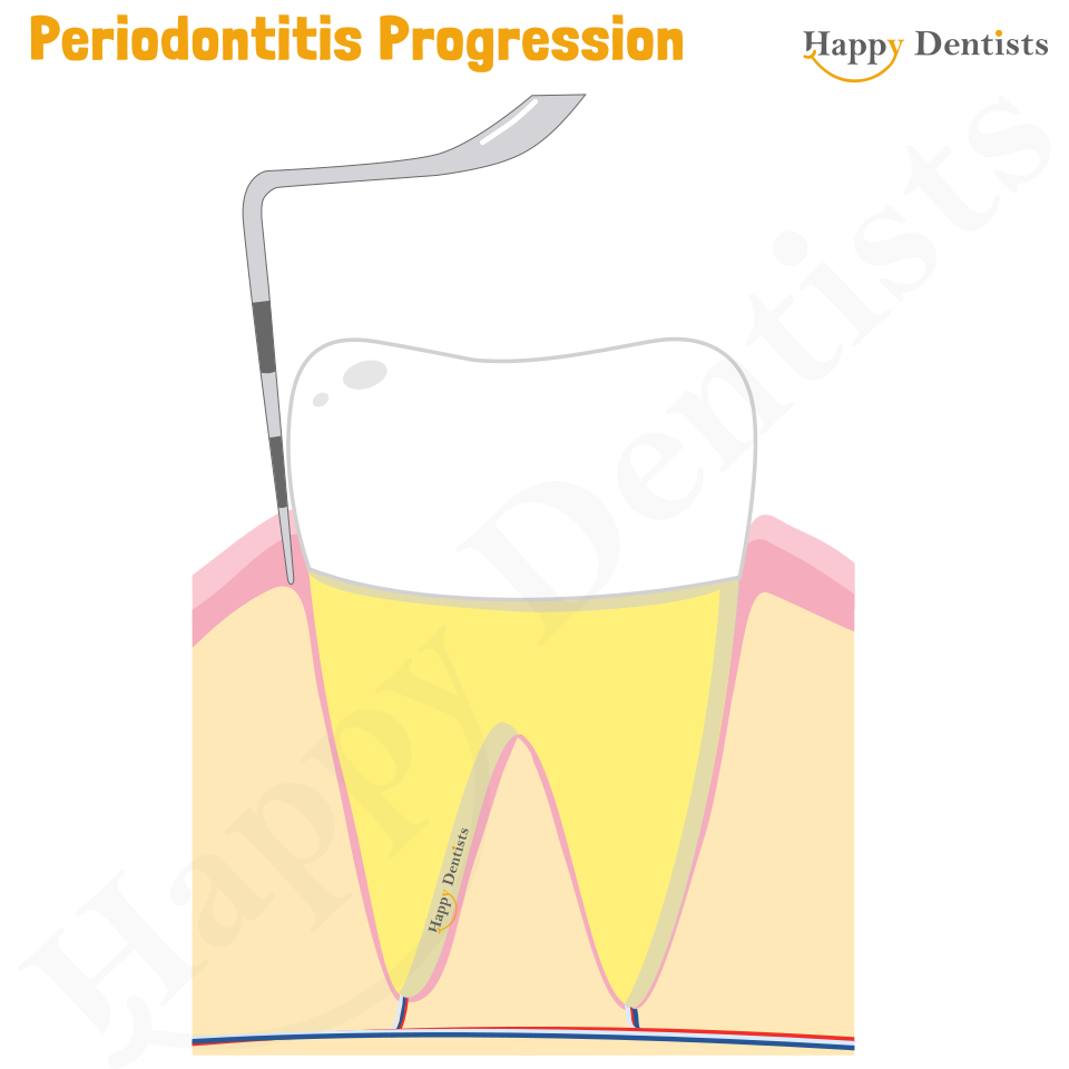 Periodontitis Animation, Periodontitis, Gum Disease