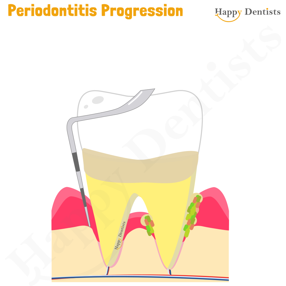 Periodontitis Animation, Periodontitis, Gum Disease