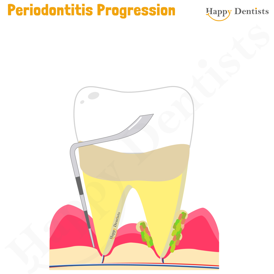 Periodontitis Animation, Periodontitis, Gum Disease